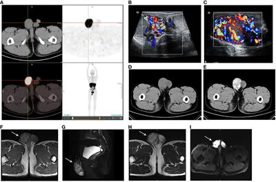 Case report: Rare case of a preoperatively diagnosed spermatic cord paraganglioma and literature review